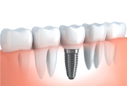 découvrez notre mutuelle dédiée aux implants dentaires, offrant des remboursements optimaux pour vos soins bucco-dentaires. protégez votre sourire tout en réduisant vos dépenses grâce à des solutions adaptées à vos besoins. obtenez un devis gratuit et profitez d'une couverture complète dès aujourd'hui !