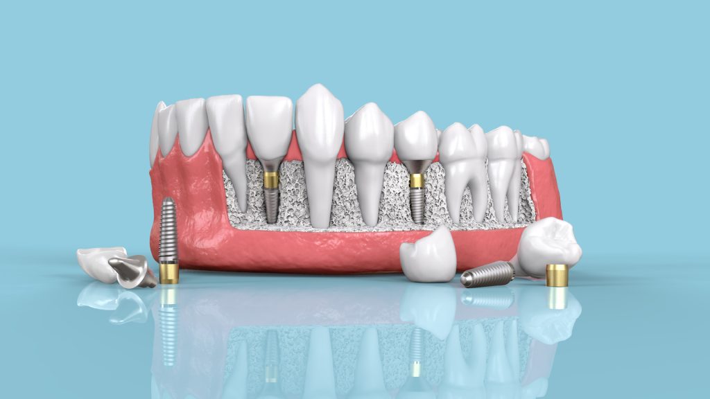 découvrez nos solutions de mutuelle implant dentaire adaptées à vos besoins. bénéficiez d'un remboursement optimal pour vos soins d'implants dentaires et assurez-vous un sourire éclatant en toute sérénité. comparez nos offres et trouvez la mutuelle qui vous convient le mieux.