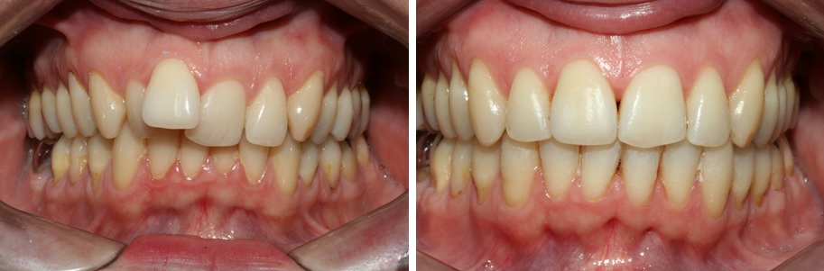 découvrez les solutions d'orthodontie adulte pour un sourire éclatant et aligné. nos traitements personnalisés s'adaptent à vos besoins et vous aident à retrouver confiance en vous, à tout âge.