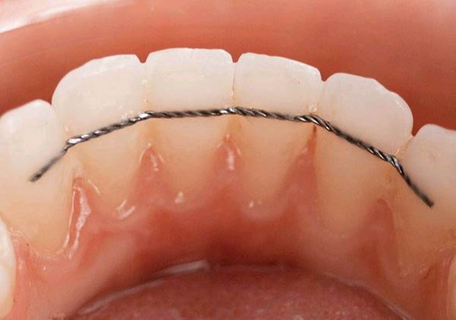 découvrez nos solutions d'orthodontie pour adultes et retrouvez un sourire harmonieux et en pleine santé. nos traitements sur mesure vous offrent la possibilité de corriger vos dents tout en préservant votre confort et votre esthétique. prenez rendez-vous dès aujourd'hui pour une consultation personnalisée.