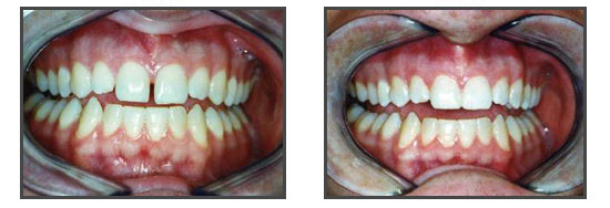 découvrez les solutions d'orthodontie pour adultes. améliorez votre sourire et votre confiance en vous grâce à des traitements sur mesure adaptés à vos besoins. prenez rendez-vous dès aujourd'hui pour en savoir plus !